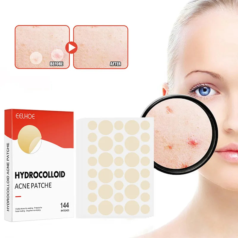 Invisible Acne Patch - 144 pieces